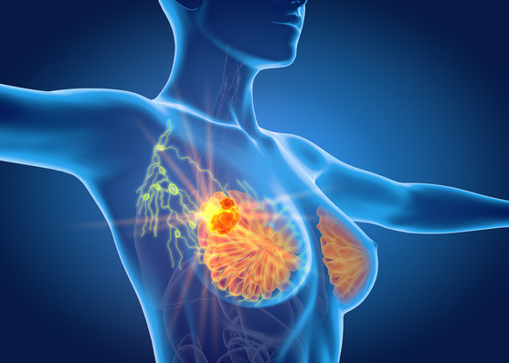 Medizinische Illustration eines weiblichen Torsos mit einem Tumor in der rechten Brust und hervorgehobenen Lymphknoten. - © Axel Kock - stock.adobe.com